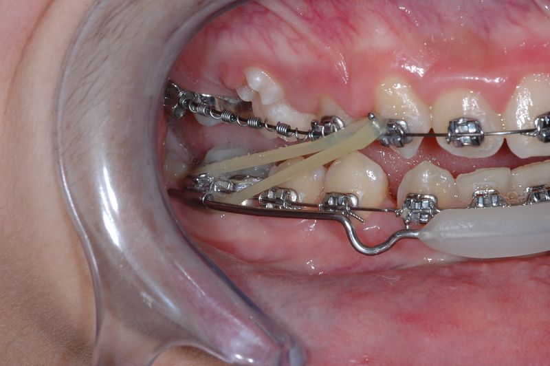 File:Caso clinico di 2¯ Classe con deep bite (2) - 1st phase of OrthoNeuroGnatodontic treatment (001).jpg