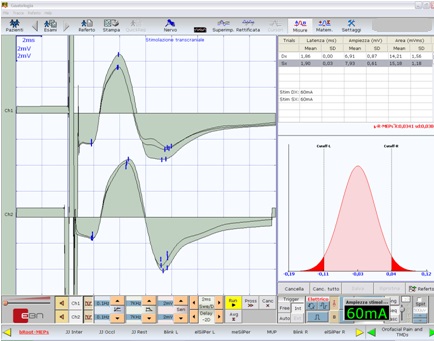 File:TCS - Motor Evoked Potentials of trigeminal roots in open bite patient.jpg