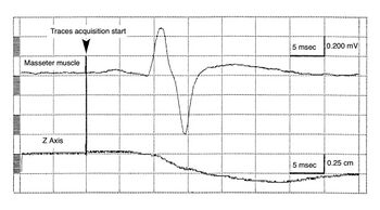 Figure 2a: The upper trace represents the neuromotor response of the jaw jerk, while the lower trace shows mandibular displacement along the Z-axis. Note that the mandible erroneously displaces vertically after the activation of masseter motor units.