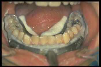 Figure 2: Paraocclusal clutch