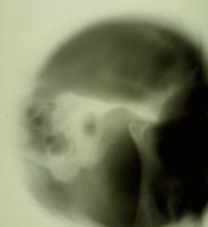 459px-Spasmo emimasticatorio ATM.jpg