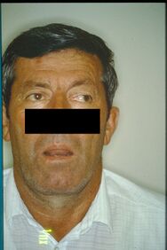 Figure 1: Myasthenic case report considered TMD despite the mouth opening being greater than 40mm but presenting difficulty in chewing such as to lead the dental colleagues to makeover more mobile prostheses with increased vertical dimensions. After 2 months from the initial symptoms, the situation worsened with the appearance of a difficulty in swallowing. Some neurological clinical tests resulted positive: Mingazzini, index-nose, nystagmus, alteration of the swallowing reflex. These anamnestic data directed the diagnosis towards an organic neurological pathology. Subsequent laboratory tests (blood chemistry, Rx, trigeminal electrophysiological and repetitive stimulation) made it possible to formulate the diagnosis of Lambert Eaton Myasthenic Syndrome.