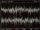 Figura 4: δ4=0⟶ Tracciato EMG del muscolo massetere (rispettivamente massetere superiore/destro e sinistro). Il test mostra simmetria bilaterale nel reclutamento delle unità motorie