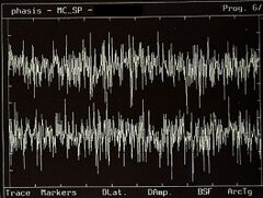 Figura 2c: Functionally symmetrical interferential EMG pattern