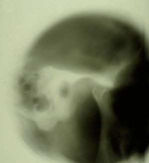 366px-Spasmo emimasticatorio ATM.jpg