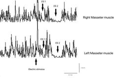 Figure 7: γ3= Periodo di silenzio meccanico rilevato elettrofisiologicamente sui masseteri destro (tracce sovrapposte superiori) e sinistro (tracce sovrapposte inferiori)