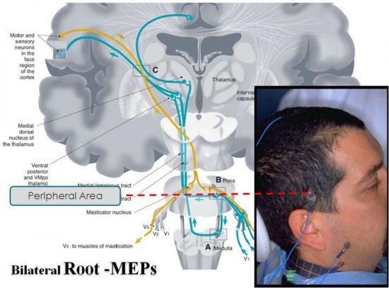 Bilateral Root-MEPs