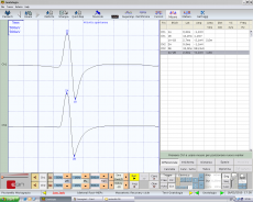 Figura 5: γ2 Jaw jerk.