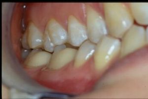 345px-Clicker NGF3.jpg