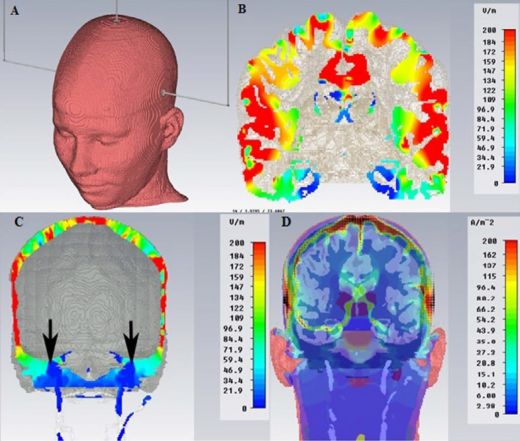 Figure: A. Positioning of the electrodes for the delivery of the electrical stimulus. B. Representation of the electric field within the brain structure. C. Localization of the induced electric field at the level of the trigeminal roots