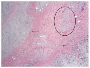 Pleomorphic adenoma 2.jpeg
