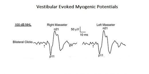 Figure: EMG trace representing a vestibular evoked potential recorded on the masseter muscles. Note that p11 and n21 indicate the potential latency at 11 and 21 ms from the acoustic stimulus