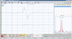 Figure 12b: Determination of the functional component of the Central Nervous System. Results for patient 2 (normocclusion) show an area of 1.37 mV / ms and 0.13 mV / ms on the right and left masseter, respectively. This shows a 90.5% symmetry difference.