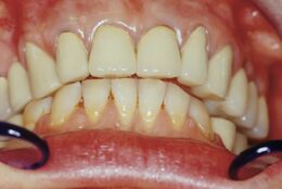 Figure 6: Centric occlusion defined through data indications of the dynamometric platform.