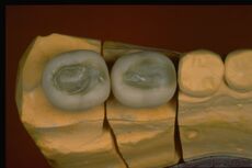 Figure 6c: Frozen Functional Neuro Evoked Centric Registration by placing crown structures in Empress with wax and brought back into the articular.