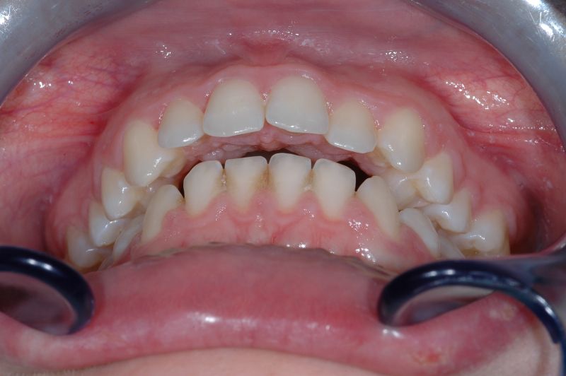 File:Invisible OrthoNeuroGnathodontic before treatments.jpg