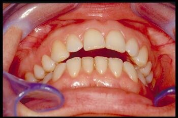 Figure 2: Post-polio syndrome was previously diagnosed with TMD and Occlusal-Postural disorder in reference to orofacial pain and vertigo phenomena despite the mandibular opening being greater than 40 mm. The anamnesis reported only an interesting correlation between the pain side and poliomyelitis contracted in childhood. On needle electromyographic examination of the temporal muscle, the recorded potentials showed a neuropathic picture with spontaneous activity, motor units of abnormal amplitude (> 2 mV) attributable to neuropathic suffering and reinnervation phenomena. The previous illness and the EMG examination led to a diagnosis of 'Post-polio syndrome'.
