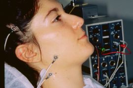Figura 5b: Posizionamento degli elettrodi registranti sui masseteri di ambo i lati e degli elettrodi per evocare la risposta diretta dalle radici trigeminali