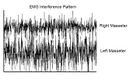 Figure 6: δ1 EMG Interference Pattern