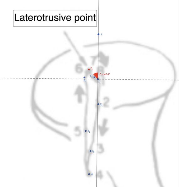 File:Angolo laterotrusivo TMJ.jpg