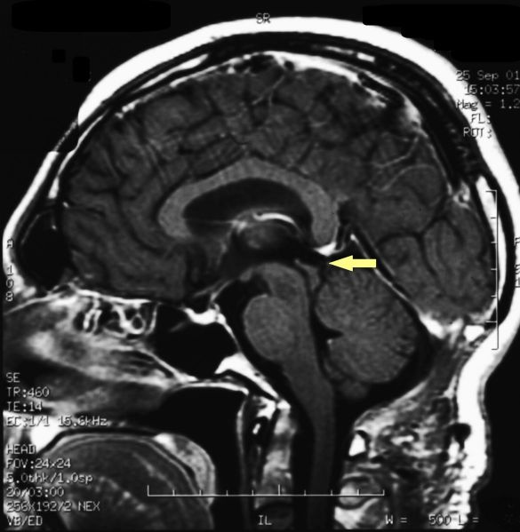 File:Pienal cavernoma post surgery 2.jpeg