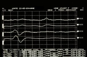 Figure 3: Mandibular reflex detected electrophysiologically on the right (upper traces) and left (lower traces) masseters.