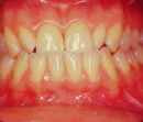 Figura 9a: Vista frontale della riabilitazione Neuro evocata Funzionale e ripristino normocclusale incisale con due corone in Empress ( lavoro eseguito nel 1992)