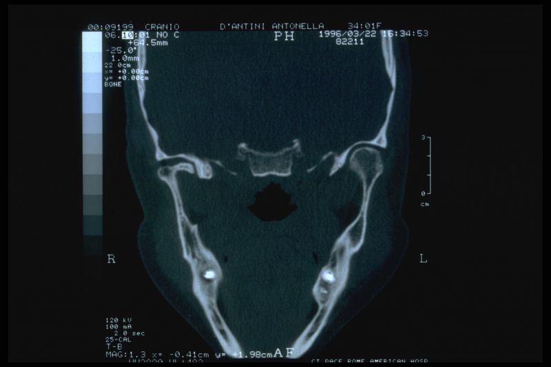 File:TC -TMJ.jpg