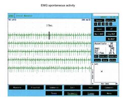 Figura 1b: Analisi della frequenza di scarica delle unità motorie masseteri (MUs)