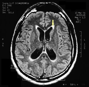 Pineal cavernoma pre surgery 1.jpeg