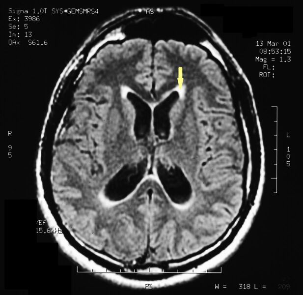 File:Pineal cavernoma pre surgery 1.jpeg