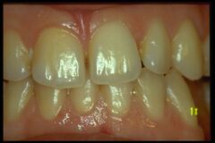 Figure 1b: Mandibular spatial position misalignment