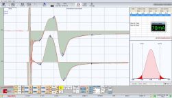 Figure 11b: Determination of the anatomical symmetry of the patient's nervous system "figure 1 malocclusion". The graph area (latency-amplitude) gives for the right side the value 9.7 mV / ms for the left side a value of 9.69 mV / ms. This indicates a symmetry of 0.1%.