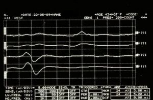 350px-Spasmo emimasticatorio JJ.jpg