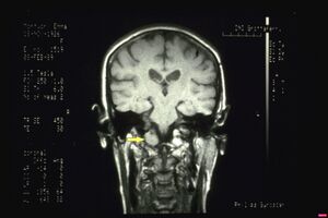 Figura 7: Sezione coronale dell'encefalo a livello del midollo allungato in cui si evidenzia una massa ( freccia) che invade parzialmente il frame ovale