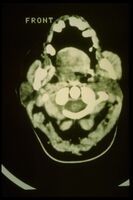Figure 8: γ3= La TC mostra un'evidente ipertrofia del massetere destro