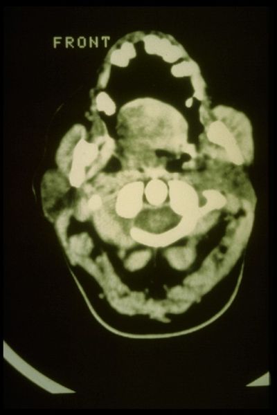 File:Spasmo emimasticatorio TC.jpg