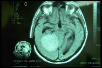 Figure 1d: Obviously after these results, the patient cannot be considered affected by postural disorder but by organic neurological pathology and the Nuclear Magnetic Resonance of the brain shows it in all its diagnostic potential.