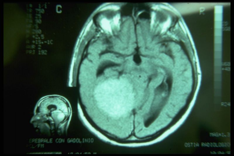 File:Meningioma 5 by Gianni Frisardi.jpeg