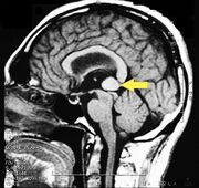 γ5= MR imaging of Pineal Cavernoma: The conclusion of the process as already described indicates that a Cavernosa Pineal is very difficult to attack due to its anatomical position. The patient was referred to a specialist center in neurosurgery in Verona by Prof. Albino Bricolo who succeeded in eliminating the vascular malformation through endoscopic surgery and giving our dear patient 'Bruxer' a dignified life without a dental bite plane.
