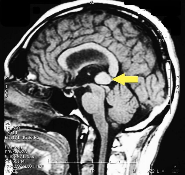 File:Pineal cavernoma pre surgery 2.jpeg