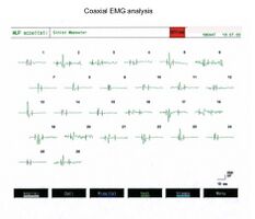 Figura 1c: Analisi della morfologia della Unità motoria masseteri (MUs)