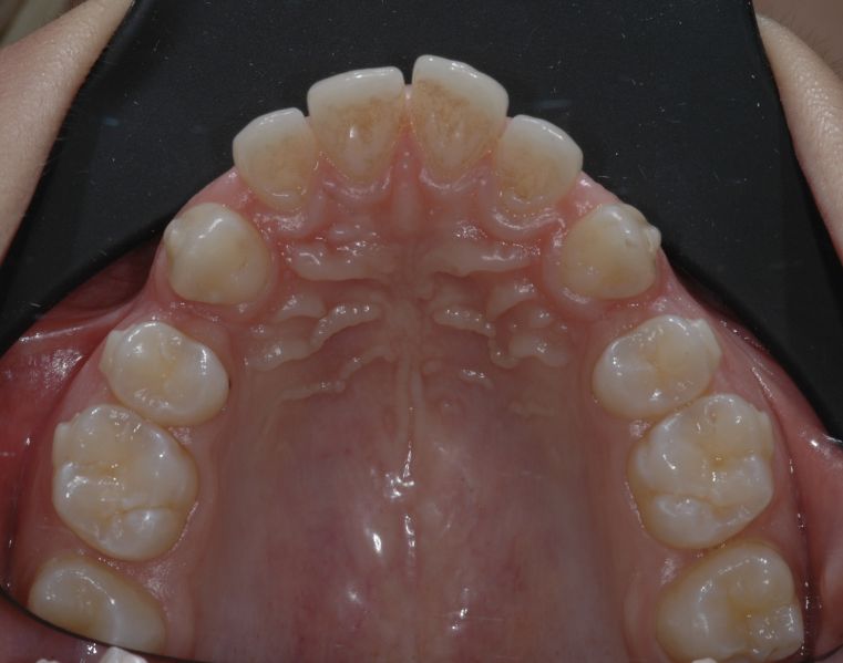 File:Occlusal view of Invisible OrthoNeuroGnathodontic treatments.jpg