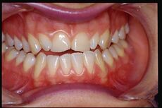 Figure 5c: Result of mandibular elevation from resting position to Centric Neuro Evoked Functional via bRoot-MEPs