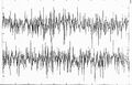 Figura 1: EMG interferenziale eseguita nell'anno 2000. Traccia successivamente considerata come operatore quantistico E^