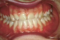 Figure 5a: Presumably pathological usual occlusal position, with anterior crossbite and wear of the central incisors