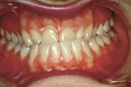 Figura 5a: Posizione occlusale abituale presumibilmente patologica, con crossbite anteriore ed usura degli incisivi centrali