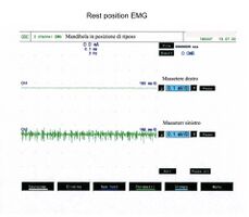 Figura 1a: EMG di superficie che mostra una ampia attività di scarica delle unità motorie (MUs) nel muscolo massetere di sinistra