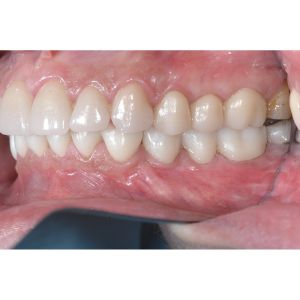 Occlusion cover fullmolars square 1200.jpg
