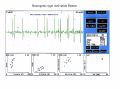 Figura 6: Traccia EMG di tipo neurogeno. Si osservano unità motorie a singola oscillazione di grande ampiezza e durata aumentata. Il pattern di interferenza completo non viene raggiunto con la contrazione volontaria massima.